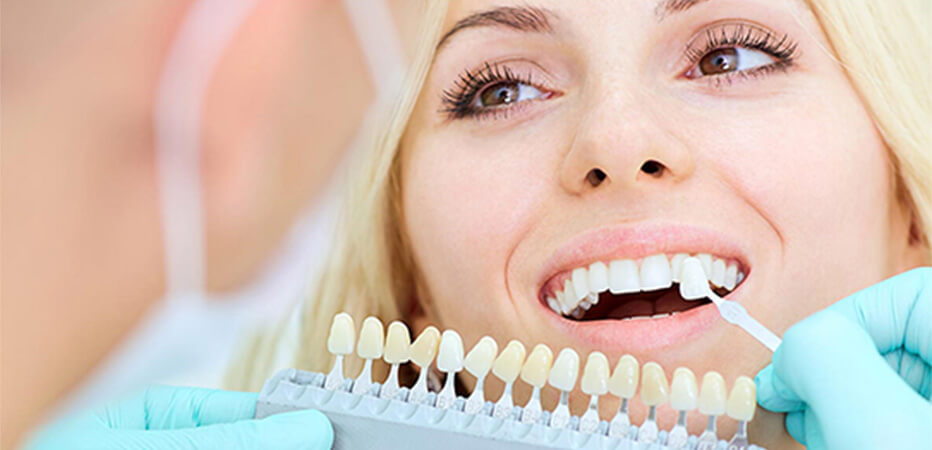 Dental Veneers