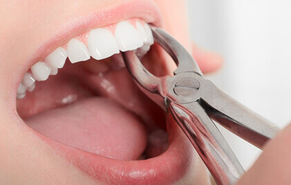 Tooth Extraction