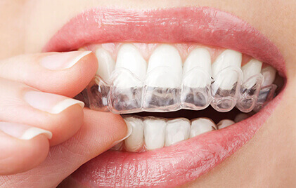 Mouthguard Dentist