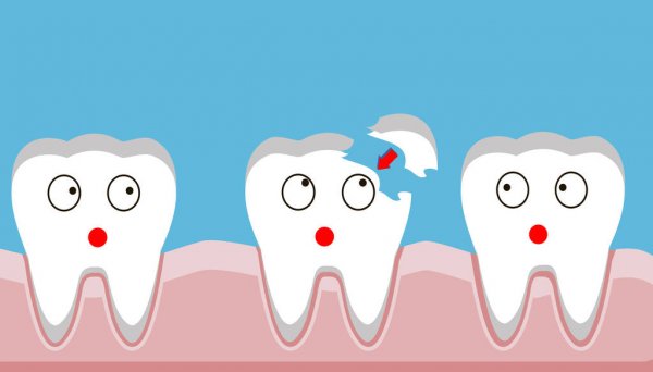 Common Tooth Injuries