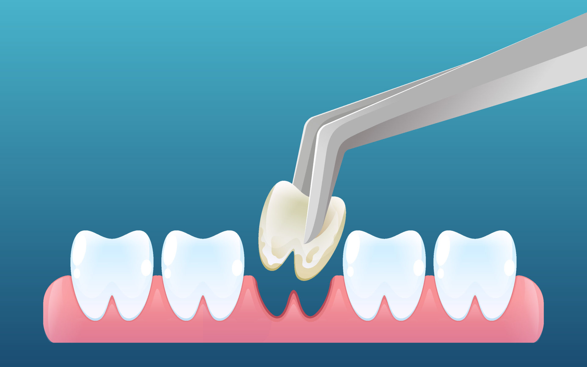 Wisdom Tooth Extraction