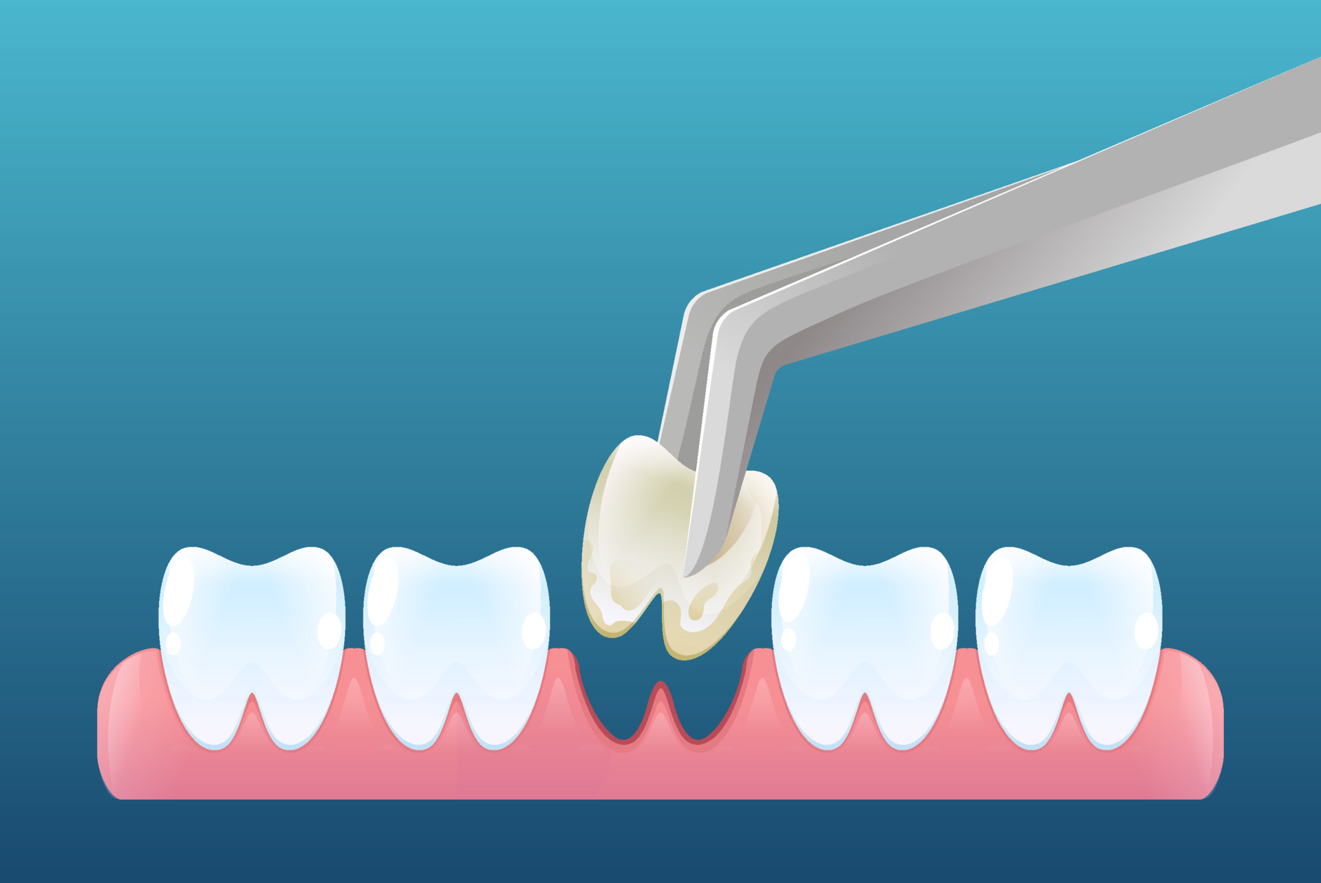 Wisdom Tooth Extraction