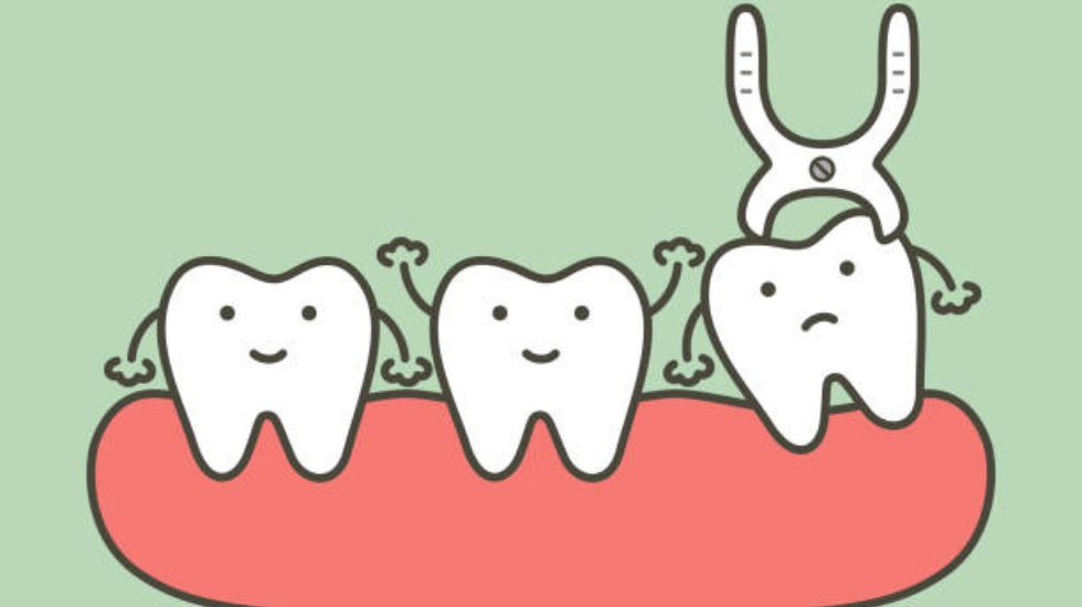 Wisdom Tooth Extraction