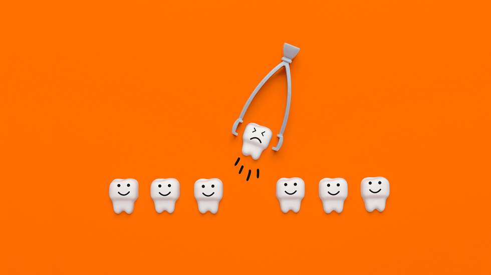 Wisdom tooth extraction - FAQs