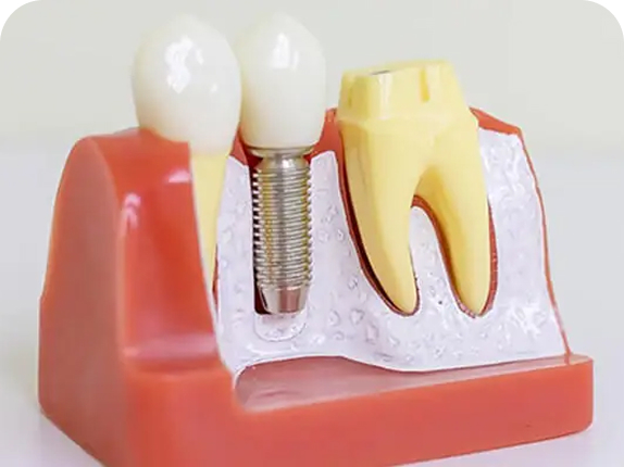 Dental Implants